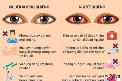 THÔNG BÁO VỀ PHÒNG CHỐNG DỊCH ĐAU MẮT ĐỎ